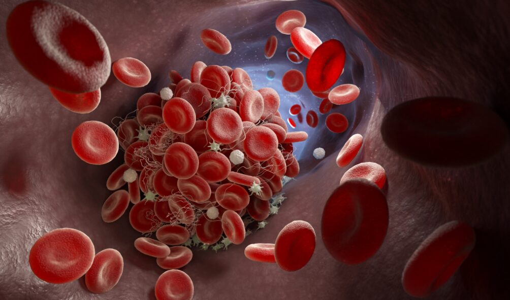 What is a Blood Clot - Causes, Symptoms, D-dimer Levels and Treatment
